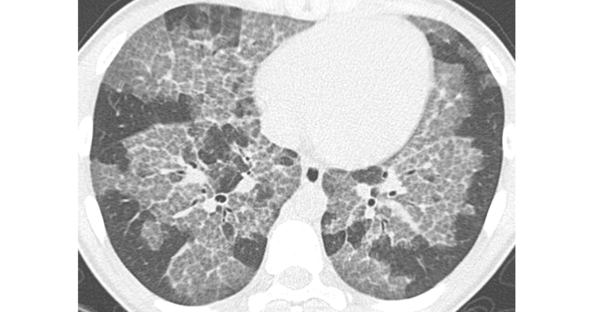 Amazon.com: High-Resolution CT of the Lung eBook : Webb, W